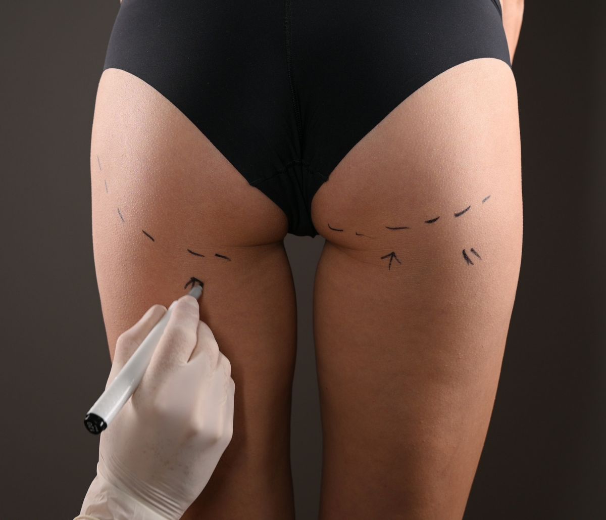 Closeup View of Female Buttocks Marked for Plastic Operation, on Gray Background