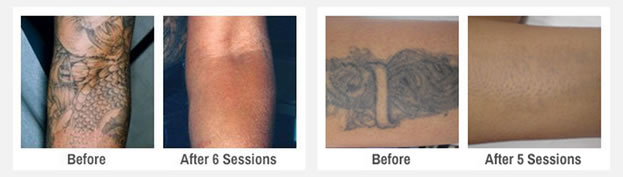 Laser Tattoo Removal | Before and After | Prime Aesthetica