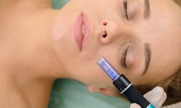 microneedling procedure on face