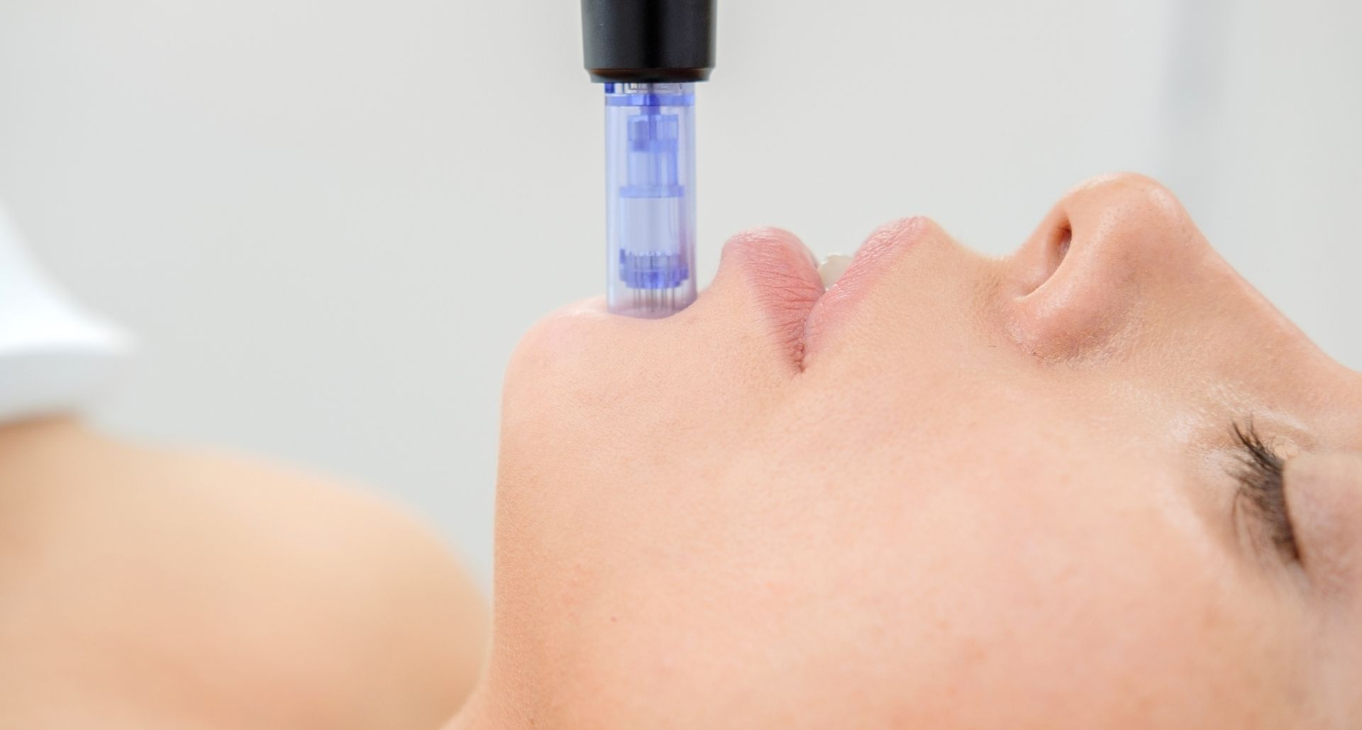 woman receiving microneedling