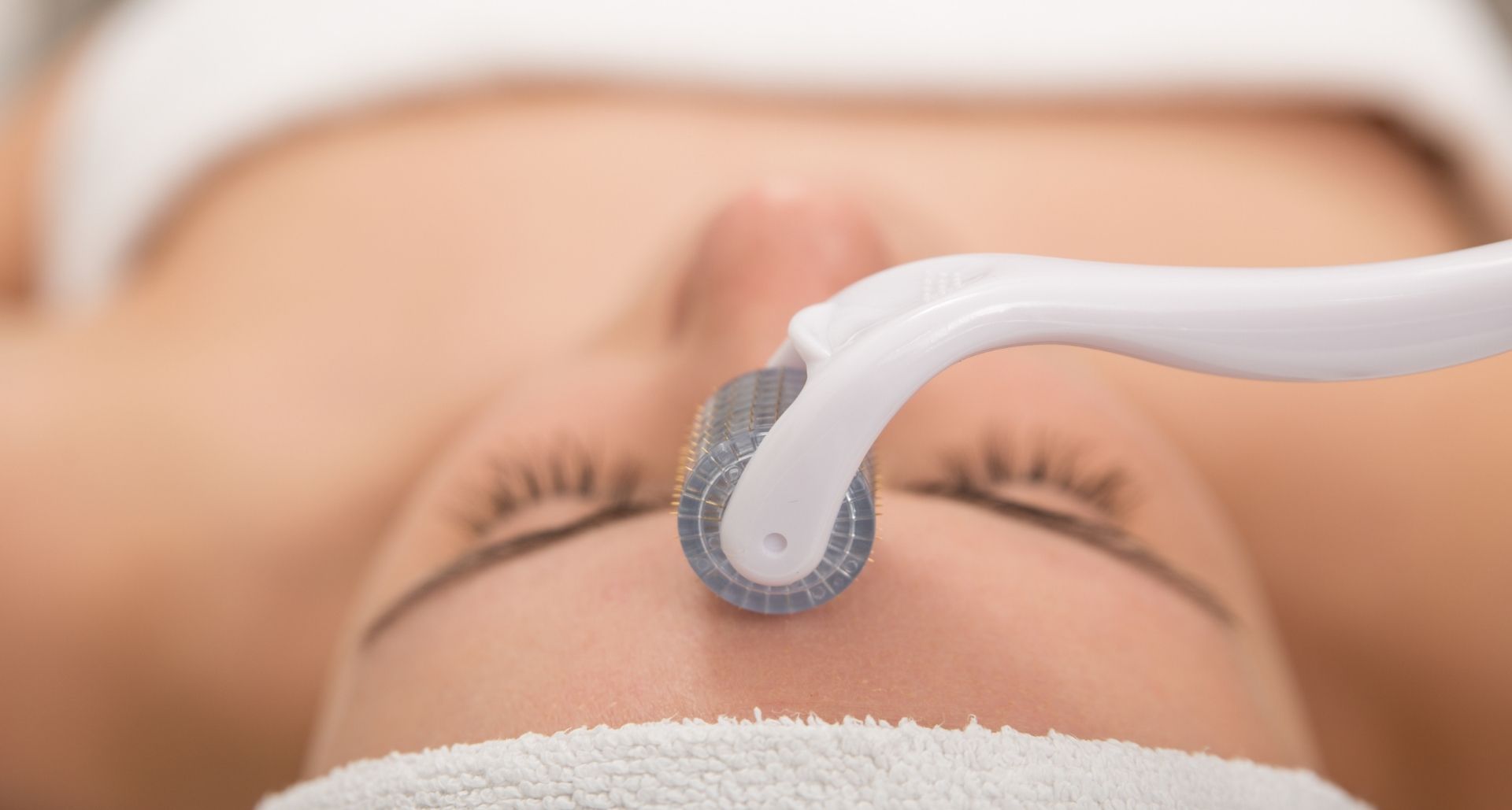 A good candidate for Microneedling 