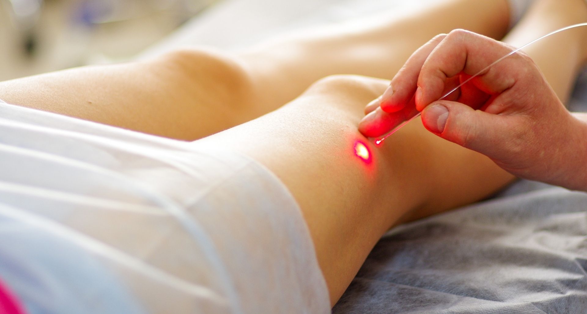 laser treatment for varicose veins