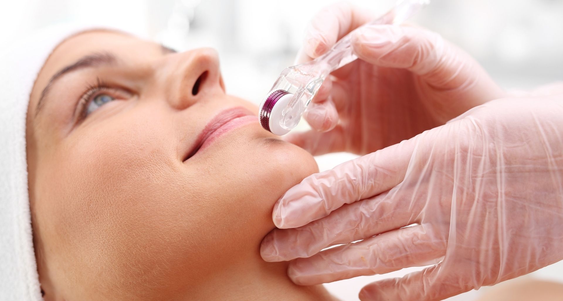 Microneedling treatment