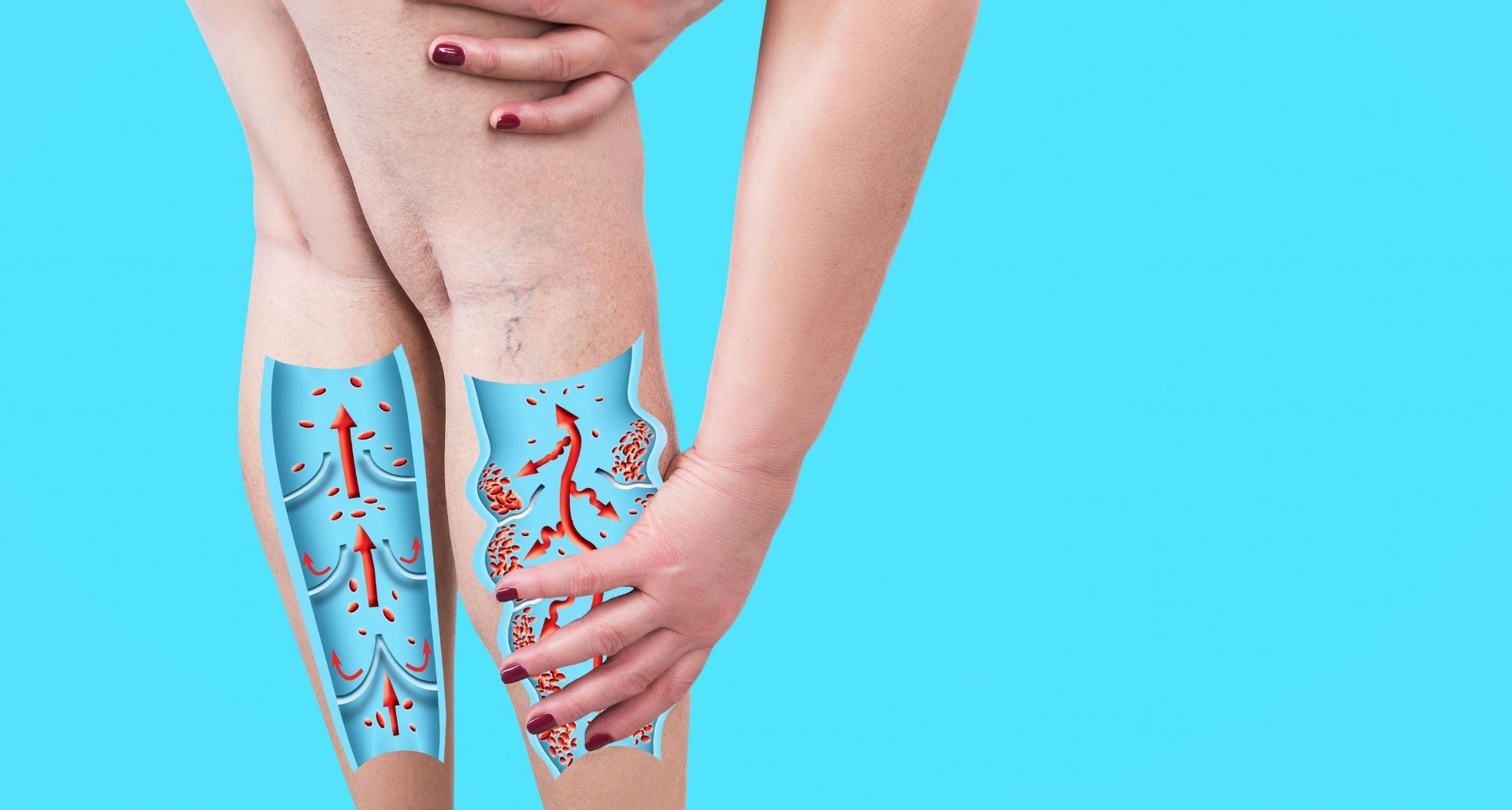 diagram of varicose veins and symptoms