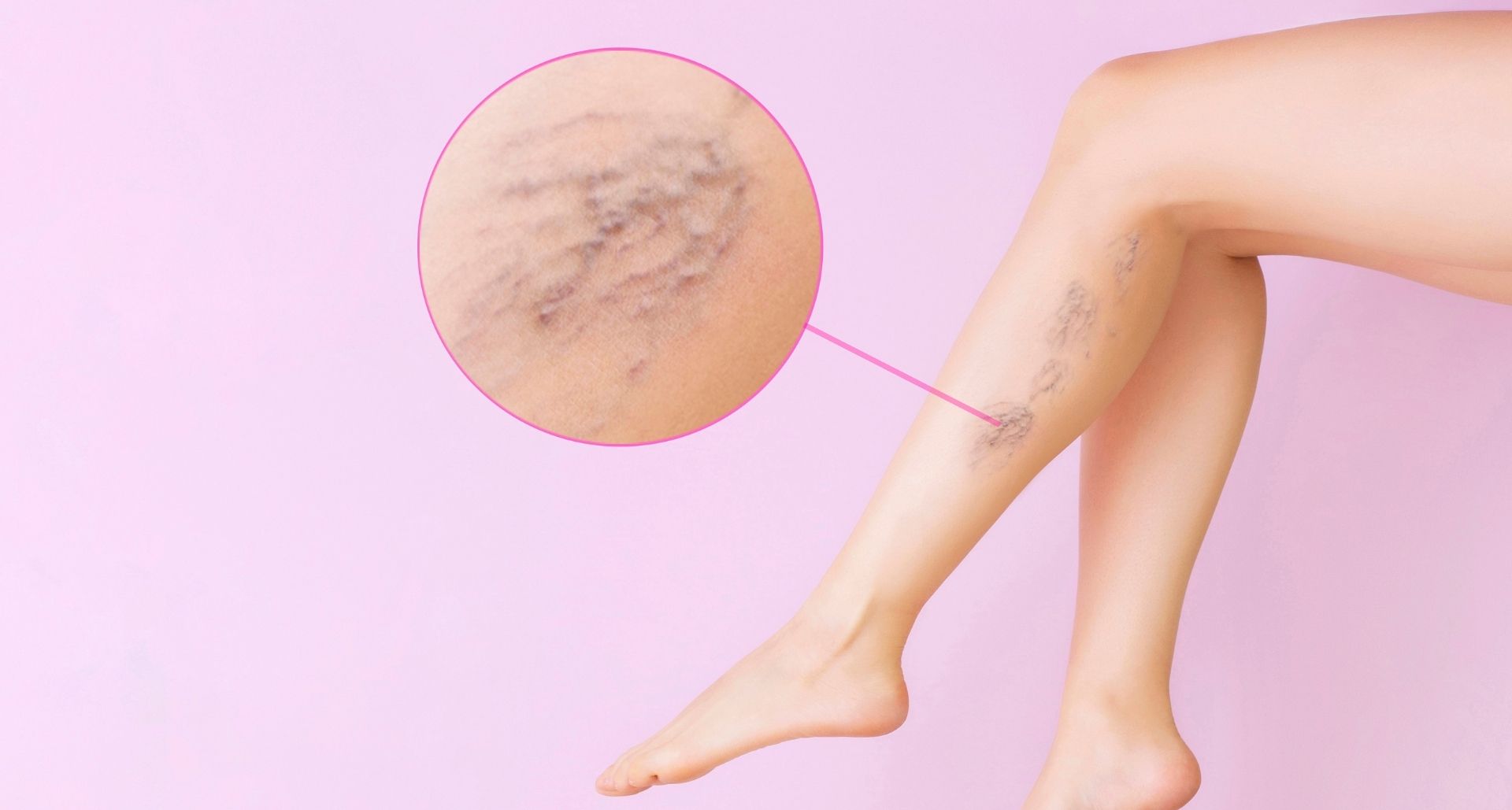 close up of varicose veins