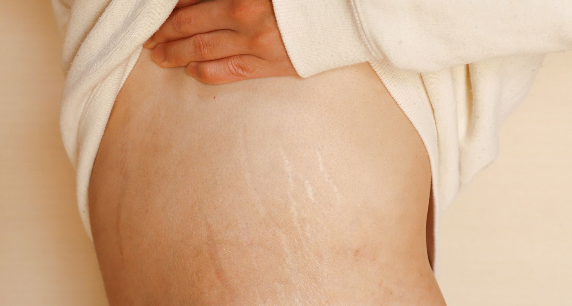 Stretch Marks in Teen Boys: Are They Normal?