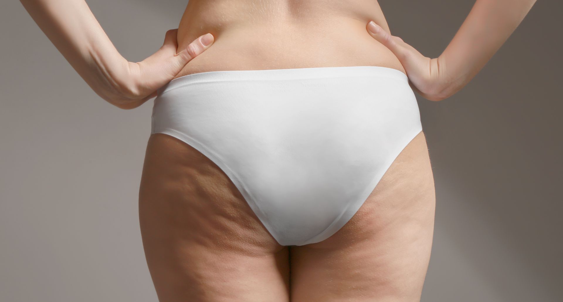 Cellulite Causes, Symptoms, and Treatments