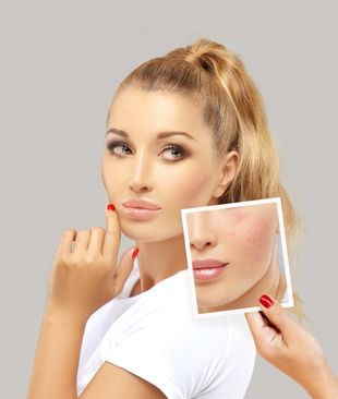 Woman after scar reduction treatment on face