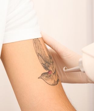 Person removing tattoo on arm 