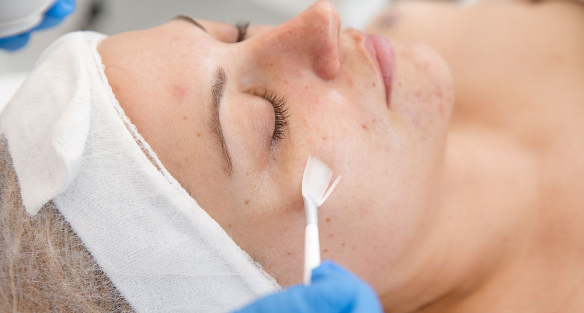 Microneedling Treatment