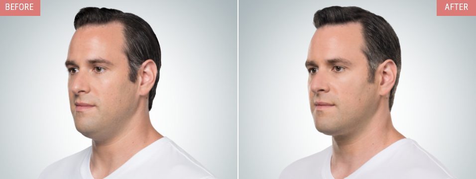 kybella before and after